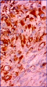 Se observa el  inmunomarcaje para la Vimentina llenado el citoplasma de las clulas epitelioide y/o rabdoides